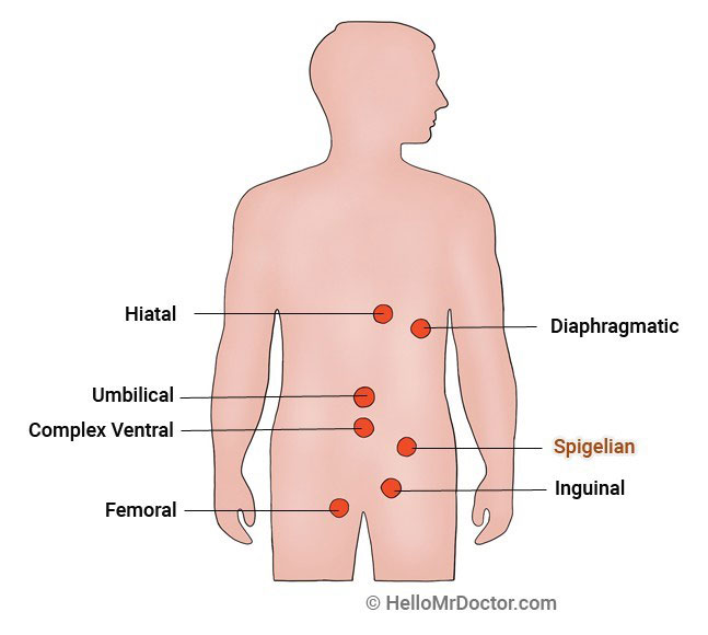 Types of Abdominal Hernias